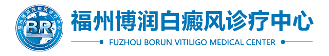 福州治疗白癜风
